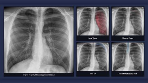 Simple Pneumothorax Explanation Of Chest X Ray Findings Youtube