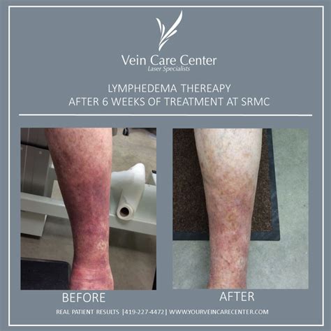 Lymphedema Therapy At Vein Care Center Ohio Lymphedema Venous