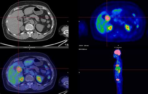 -Positron-emission tomography-computed tomography scan (7 months after... | Download Scientific ...