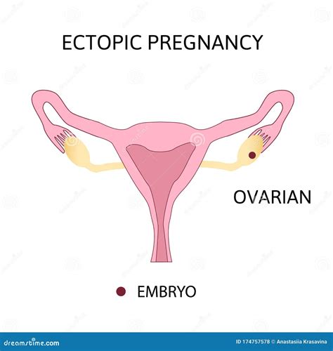 types of ovarian cysts set infographics vector illustration on isolated background