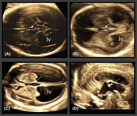 The Third Ventricle Of The Human Fetal Brain Normative Data And Pathologic Correlation A 3d