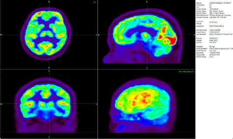 Pet Brain Scan Images Of The Right Hemisphere Depressed Patient