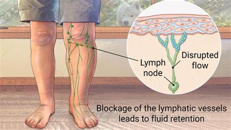 “first I Have Cancer And Now I Have Lymphedema“