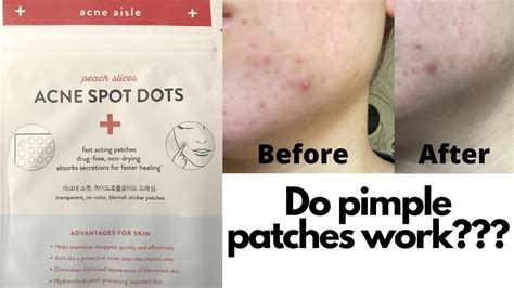 Do Pimple Patches Work I Try The Peach Slices Acne Spot Dots From Cvs