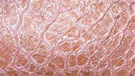 Ichthyosis Vulgaris Dry Skin Treatment Fish Scale Spring Texas