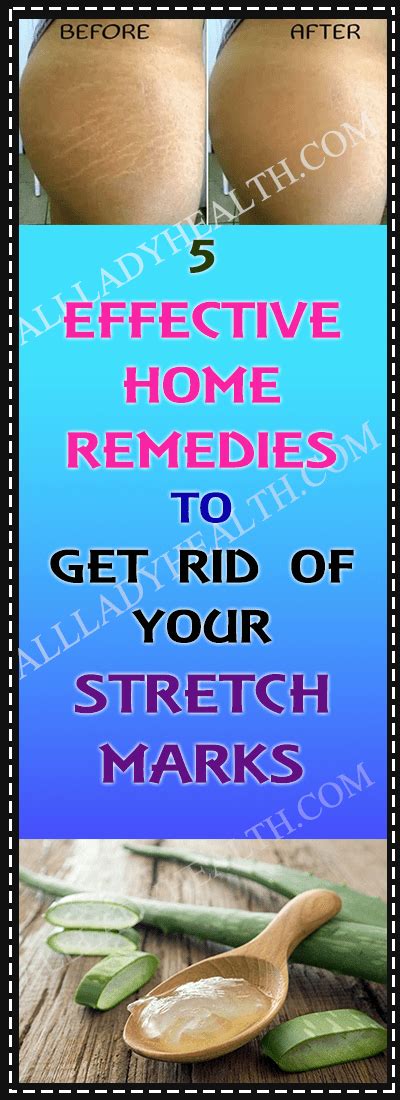 5 Effective Home Remedies For Stretch Marks Stretch Mark Remedies