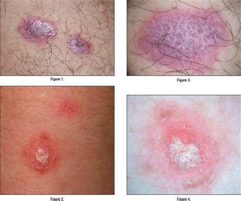 Pdf Dermoscopy Subpatterns Of Inflammatory Skin Disorders Semantic