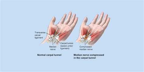 10 Risk Factors Of Carpal Tunnel Syndrome And Its Treatments