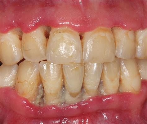 Periodontics Managing Patients With Necrotizing Ulcerative Gingivitis