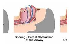 sleep snoring apnea obstructive breathing noisy during
