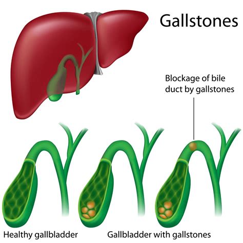 Gallstones Symptoms And Treatment Private Gastro London