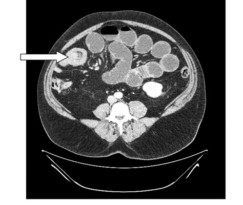 Small Bowel Intussusception In Adults The Annals Of The Royal College