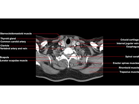 Ct Neck Axial Anatomy Radiologypicscom