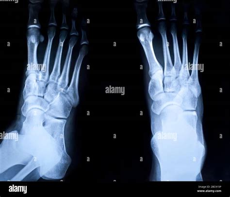 Human Foots Ankle And Leg X Ray Picture Stock Photo Alamy