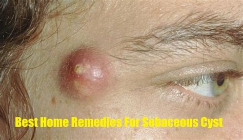 Best Home Remedies For Sebaceous Cyst Ehealthy99