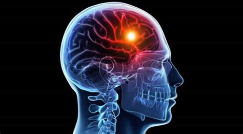 Cerebral Hypoxia Brain Hypoxia Causes Symptoms Treatment And Prognosis