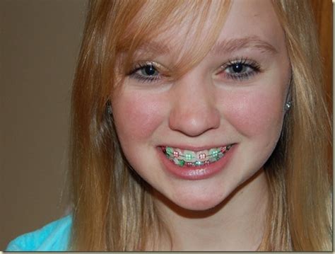 It is almost never the case that you can get braces to move your teeth from where they are that said, a skilled orthodontist will know how to balance making progress with your braces with minimizing the pain and discomfort you feel. Life at the Lunds: Wordful Wednesday-Braces and A Giveaway!