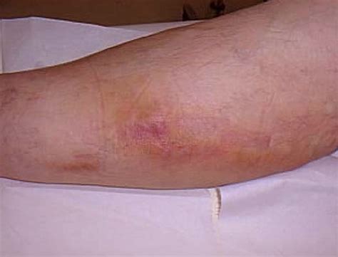 Thrombophlebitis Causes Symptoms Diagnosis And Treatment Natural