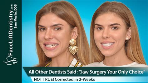 Jaw Surgery Eliminated Underbite Crossbite Misaligned Jaw Fixed In