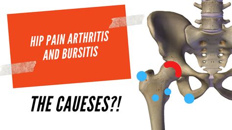 Chronic Hip Bursitis Pain