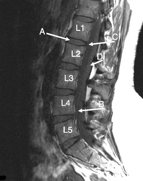 Lumbar Spine Sagittal View