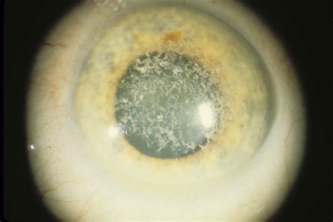 Corneal Dystrophy Granular Hereditary Ocular Diseases