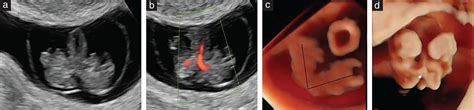 Monochorionic Diamniotic Conjoined Twins Prenatal Sonographic