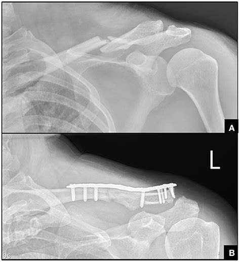 Frontiers Isolated Middle Third Clavicle Fracture Causing Horners