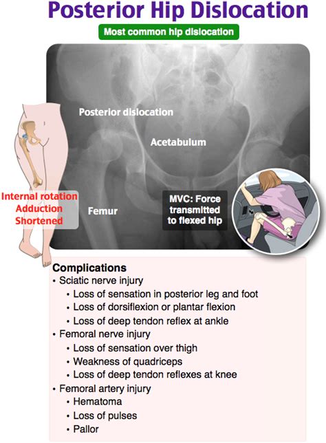 Posterior Hip Dislocation Nursing Tips Nursing Mnemonics Medical