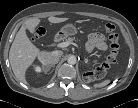 Metastatic Renal Cell Carcinoma To The Contralateral Adrenal Gland