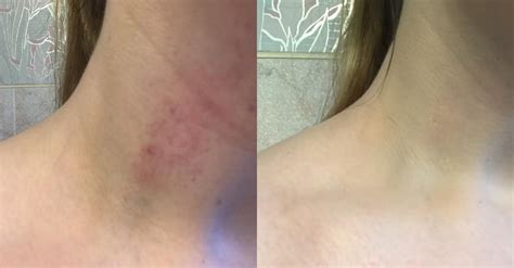 The Results How To Get Rid Of A Hickey Popsugar Beauty Photo 9
