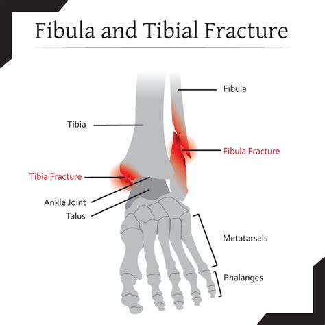 Fibula Fracture How To Heal Stars Physical Therapy