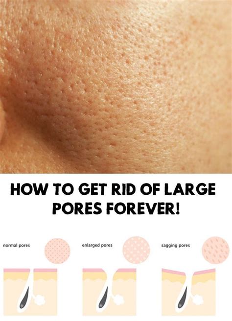 How To Get Rid Of Open Pores Forever Unclogpores Large Pores On