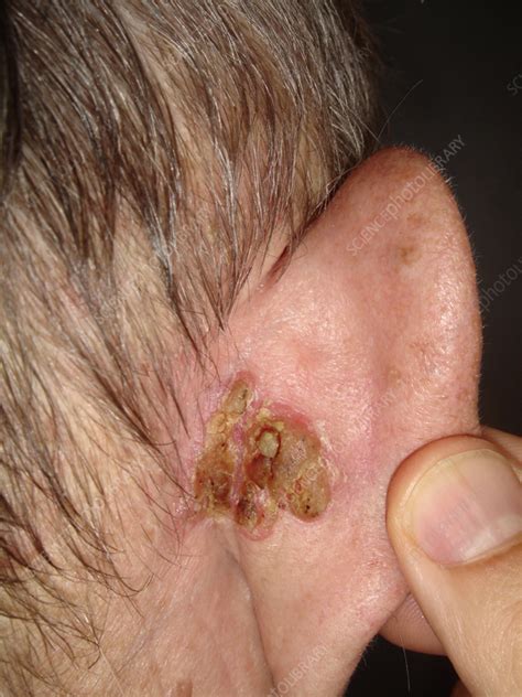 Squamous Cell Carcinoma On A Mans Ear Stock Image C0583078