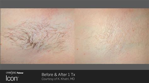 Icon Laser Hair Removal Winter Park Fl Revive Skincare Clinic