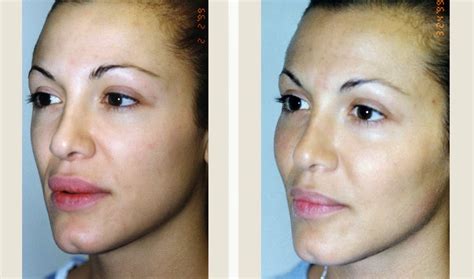 Medical Treatment Pictures For Better Understanding Cheek Augmentation
