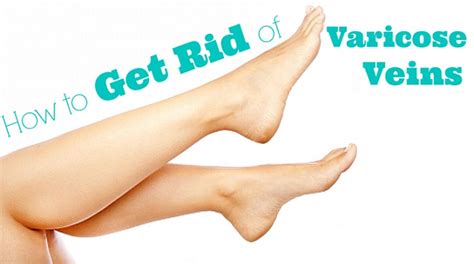 19 Best Home Remedies For Varicose Veins Home Remedies Blog