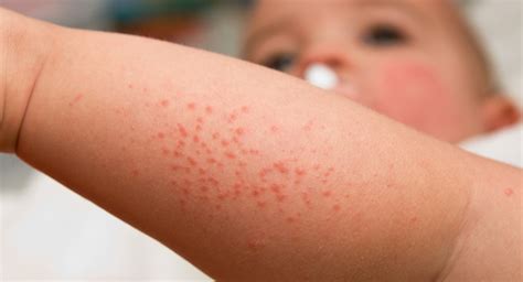 Heat Rash In Babies And Toddlers How To Spot It And What To Do About