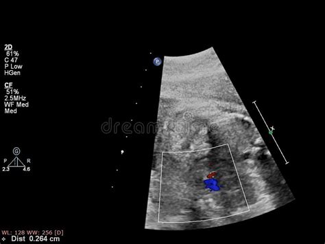 Ultrasound Examination Of The Fetal Heart Stock Photo Image Of Mother