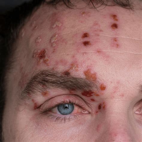 How To Recognize Shingles Around The Eye Herpes Zoster Ophthalmicus