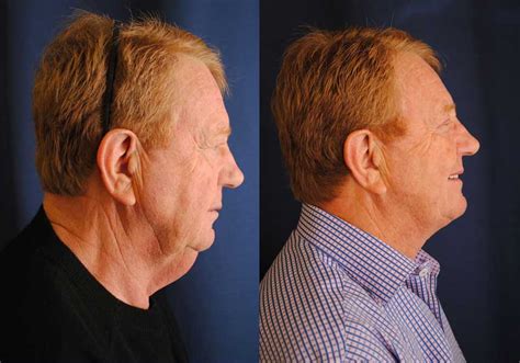 Facelift And Neck Lift Surgery Before And After Photo On Age 70 Male