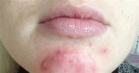 I Am Mumalicious My Battle With Hormonal Cystic Acne In Pregnancy