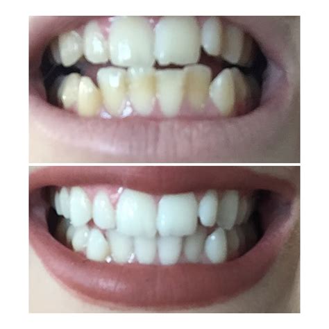 Teeth Whitening Transformation Before And After Meavy Way