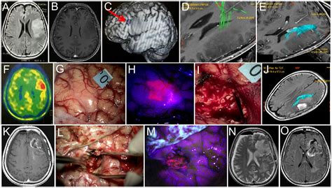 Frontiers 5 Ala Guided Tumor Resection During Awake Speech Mapping In