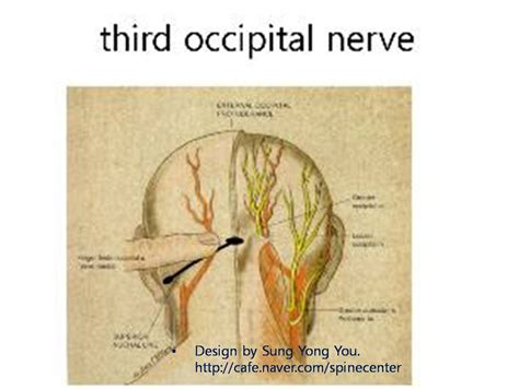Occipital Nerve Entrapment Headache두통 Nerve Entrapment Syndrome
