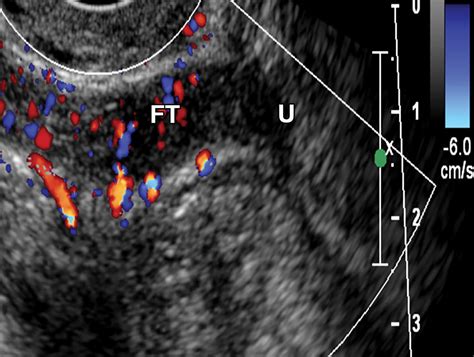 Imaging Evaluation Of Fallopian Tubes And Related Disease A Primer For