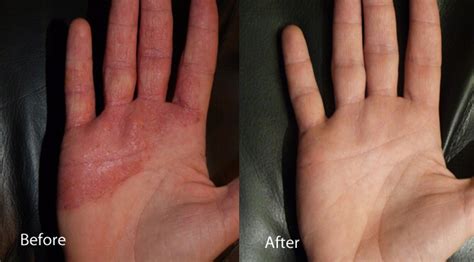 Uvb Light Therapy For Eczema Phototherapy For Eczema Before And After
