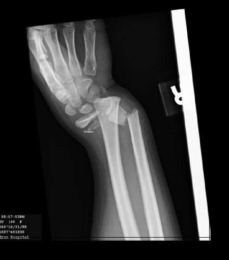 Pin By Ashley Barnwell On So Rad Broken Wrist Bone