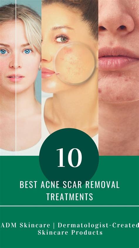 10 Acne Scar Treatments Recommended By Top Dermatologist Acne Scar
