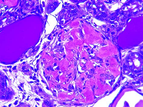 Human Kidney Methyl Violet Stain For Amyloid